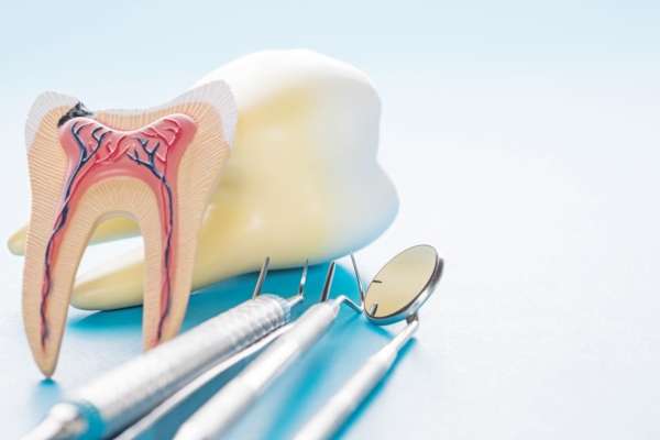 Preguntas frecuentes sobre endodoncia