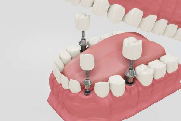 Las ventajas de los implantes dentales