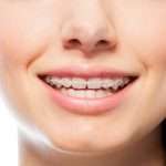Los mejores consejos sobre ortodoncia