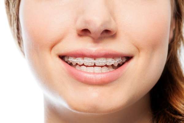 Los mejores consejos sobre ortodoncia