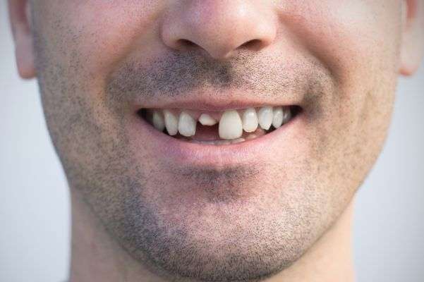 arreglar diente roto
