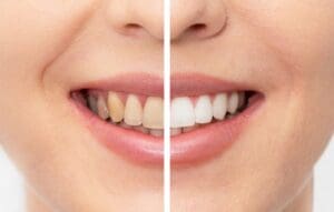 Como eliminar el color de los dientes amarillos