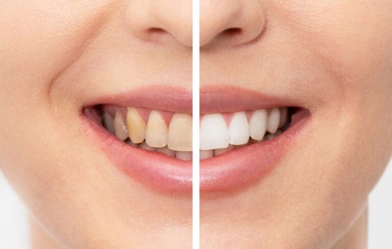 Como eliminar el color de los dientes amarillos