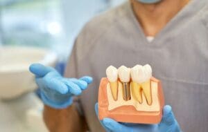 Cuáles son los riesgos de los implantes dentales