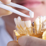 Tipos de Implantes Dentales: Encuentra Tu Solución Ideal 7 iplantes zigomasticos